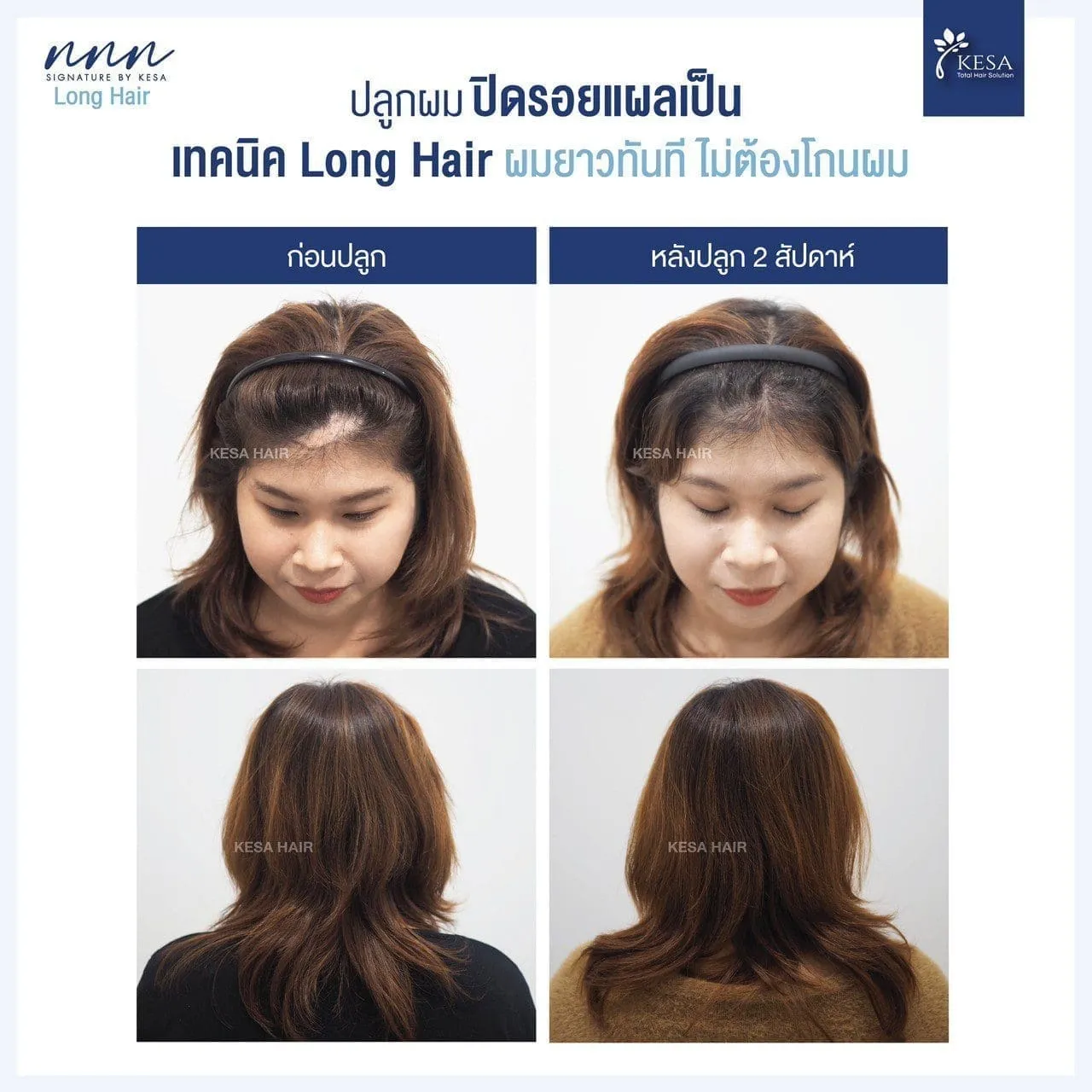 ปลูกผมปิดรอยแผลเป็น