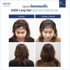 ปลูกผมปิดรอยแผลเป็น