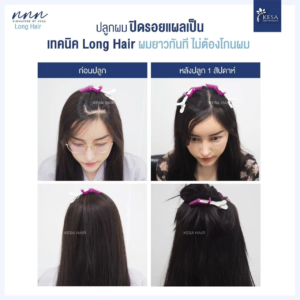 ปลูกผมทับรอยแผลเป็น
