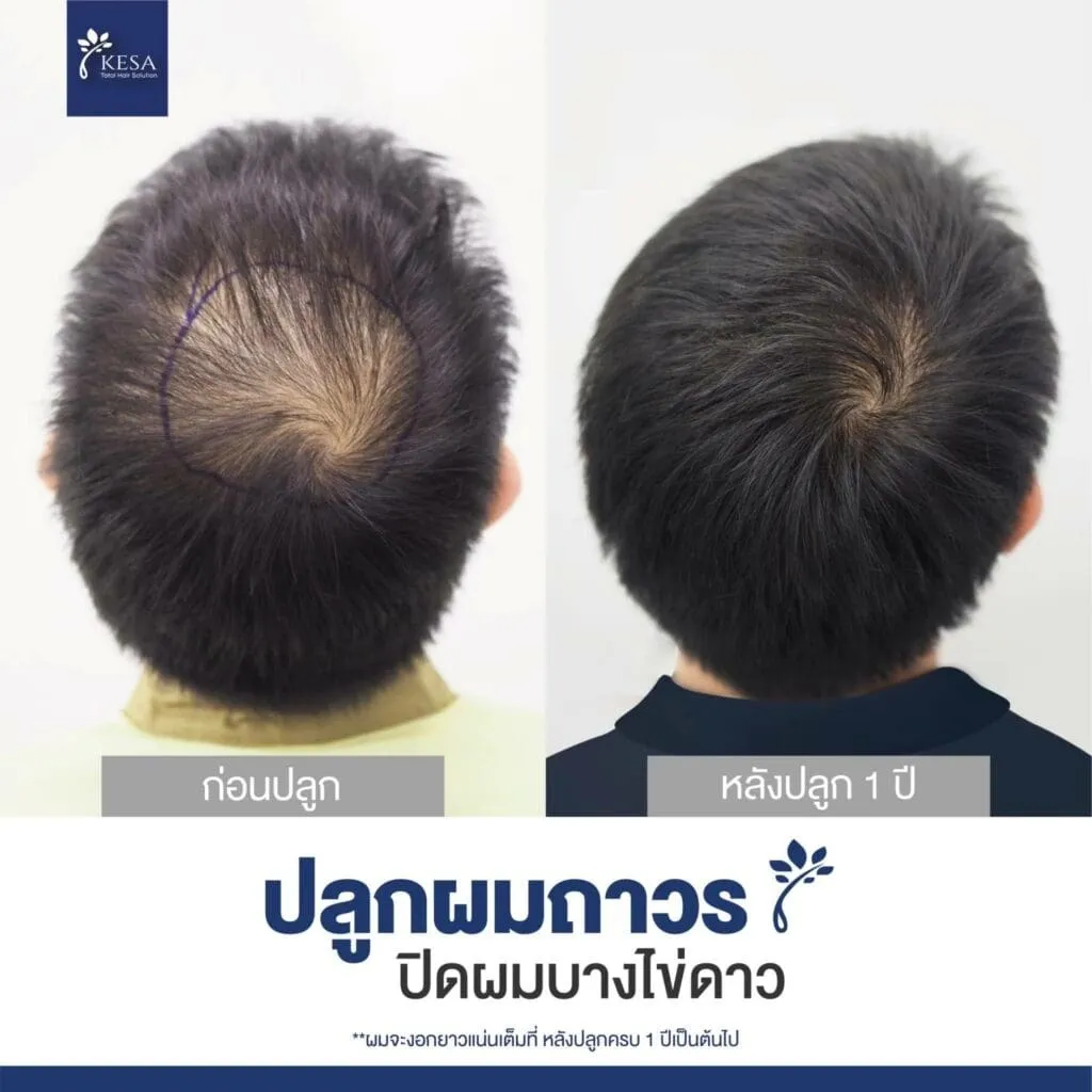 ปลูกผมกลางหัว