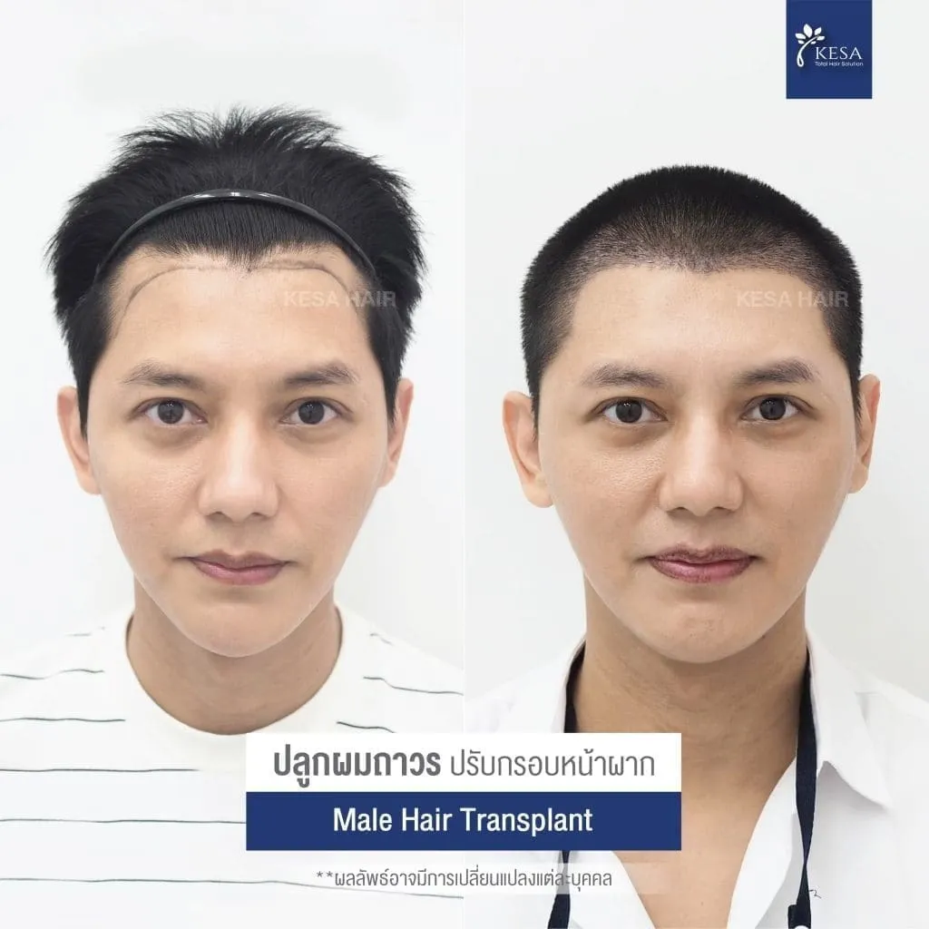 Review ปลูกผมที่เกศา