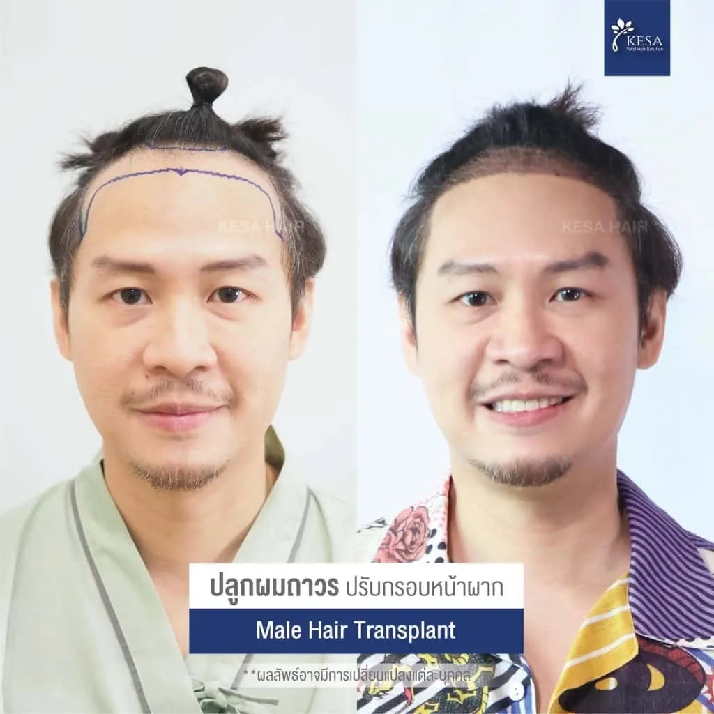 Review ปลูกผมที่เกศา