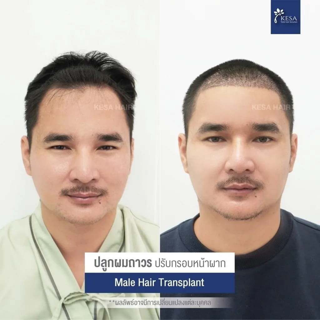 Review ปลูกผมที่เกศา