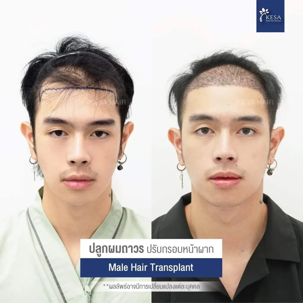 Review ปลูกผมที่เกศา