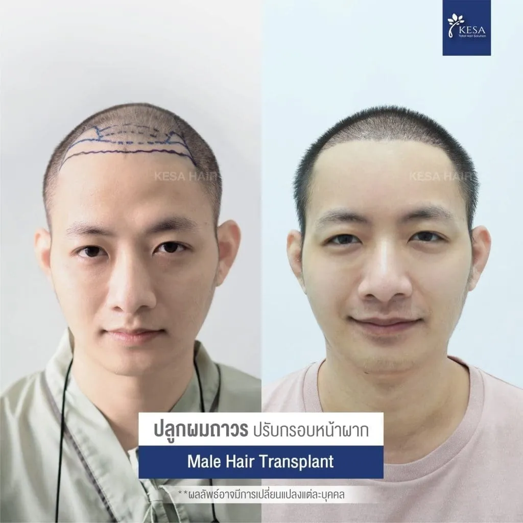 Review ปลูกผมที่เกศา