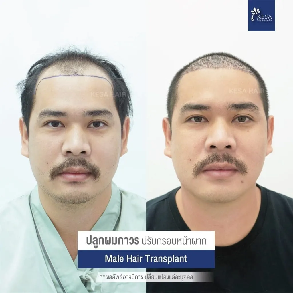 Review ปลูกผมที่เกศา