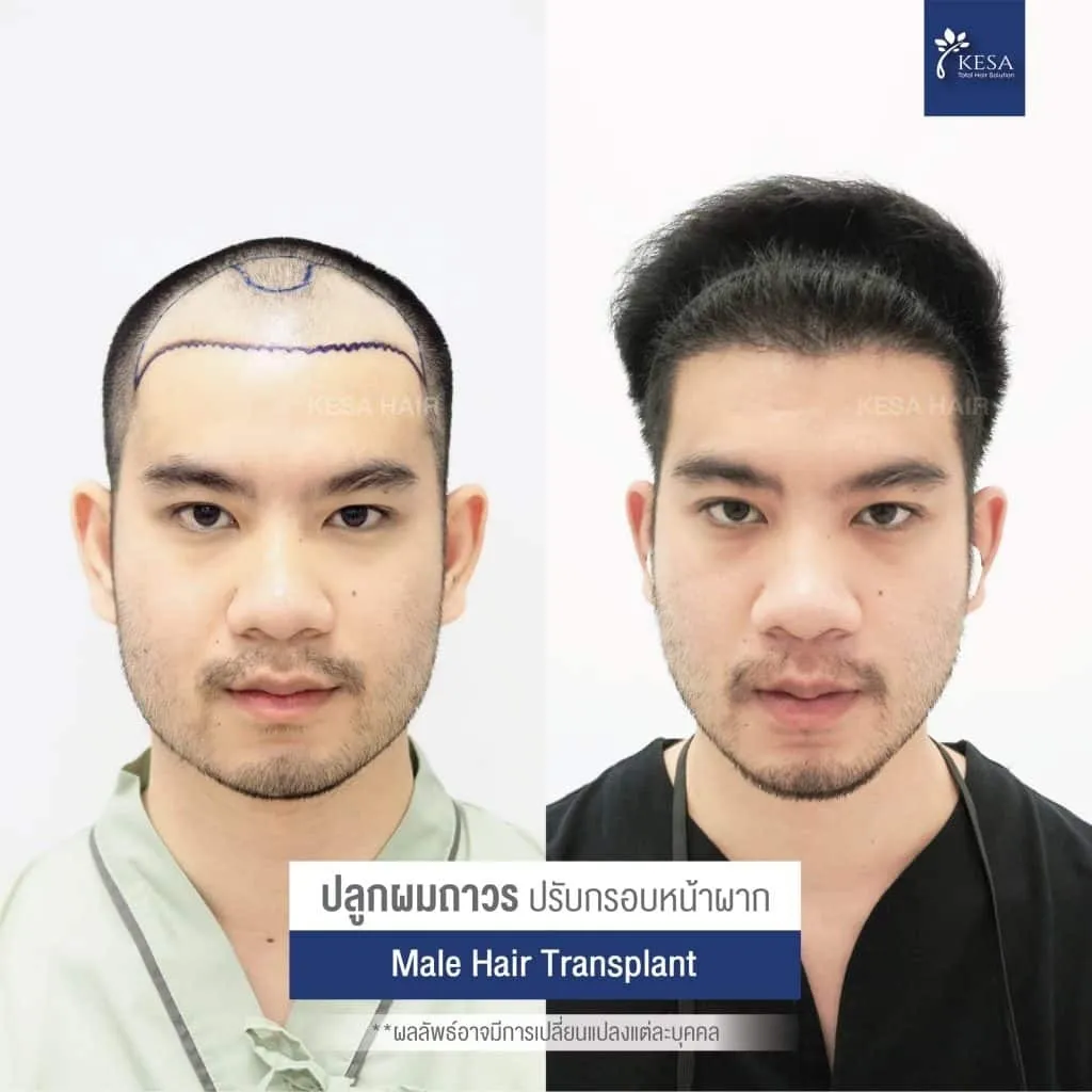 Review ปลูกผมที่เกศา