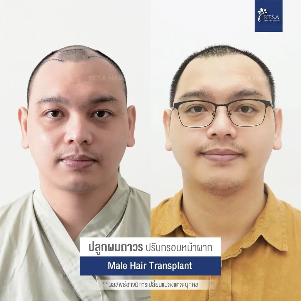 Review ปลูกผมที่เกศา