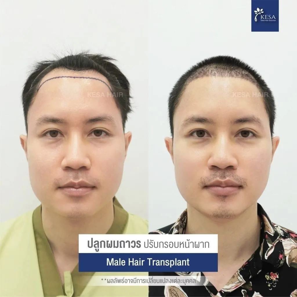 Review ปลูกผมที่เกศา