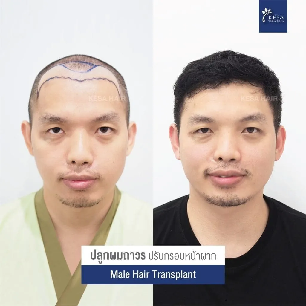 Review ปลูกผมที่เกศา