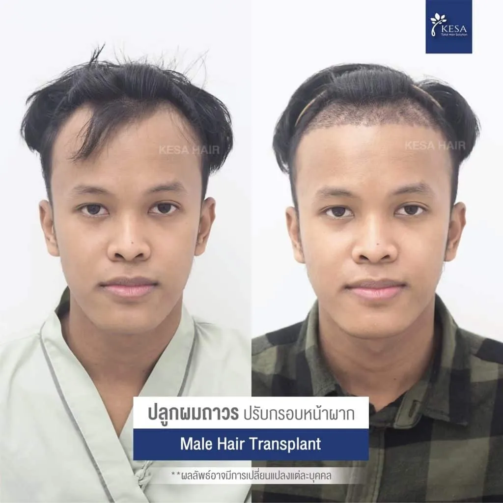 Review ปลูกผมที่เกศา