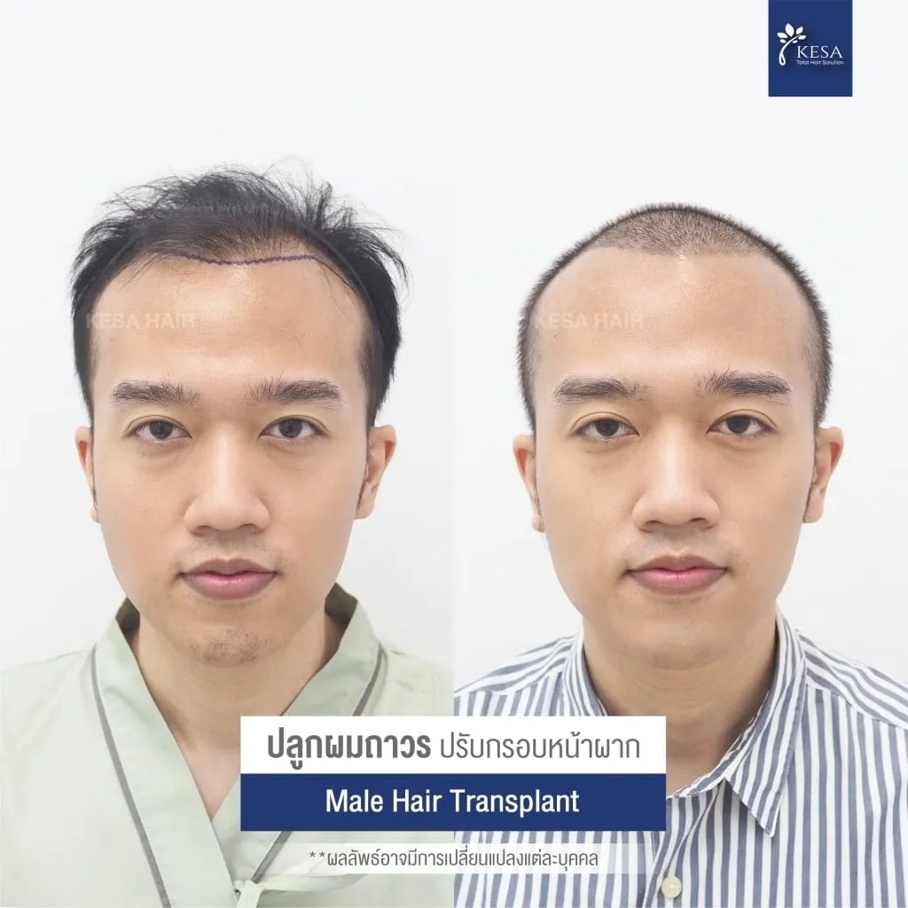 Review ปลูกผมที่เกศา