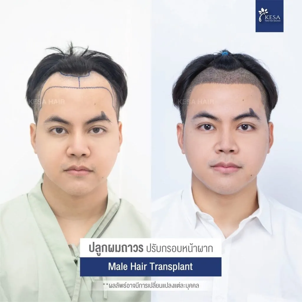 Review ปลูกผมที่เกศา