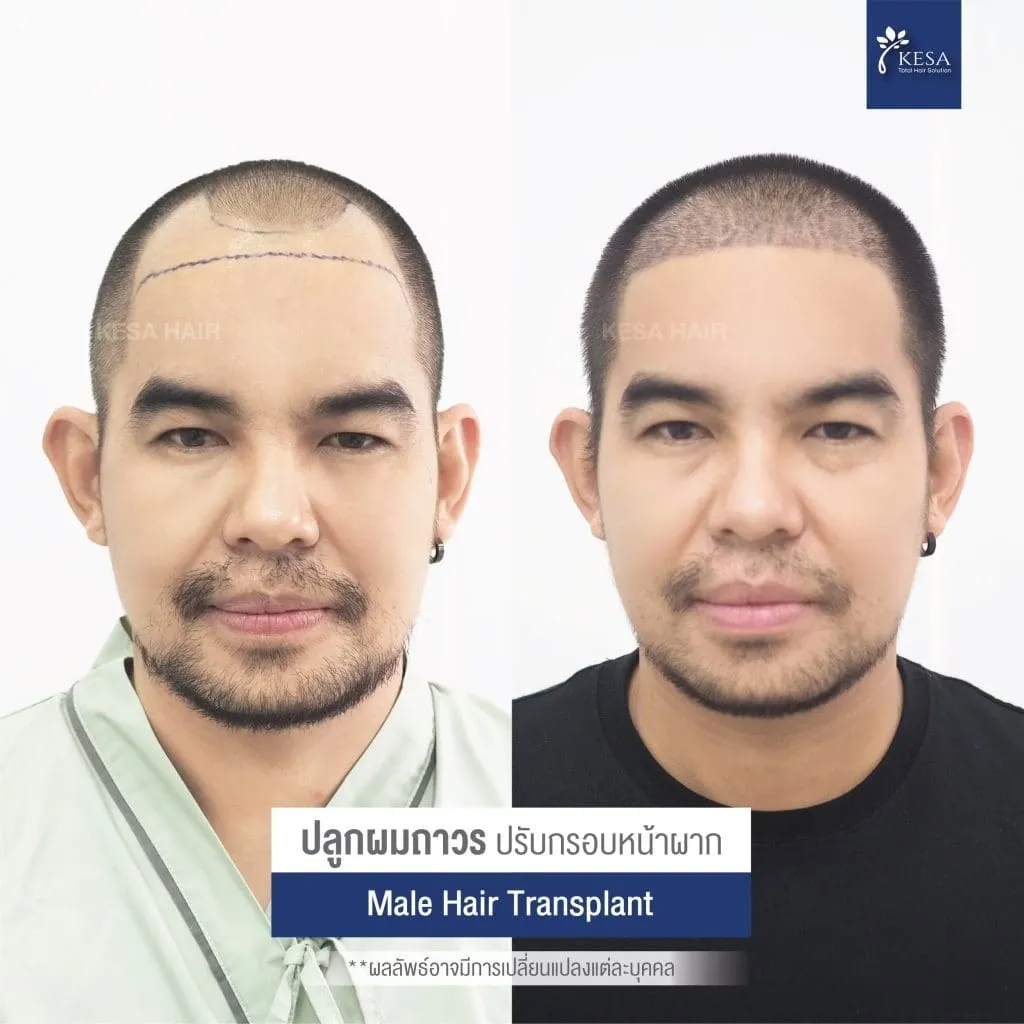 Review ปลูกผมที่เกศา