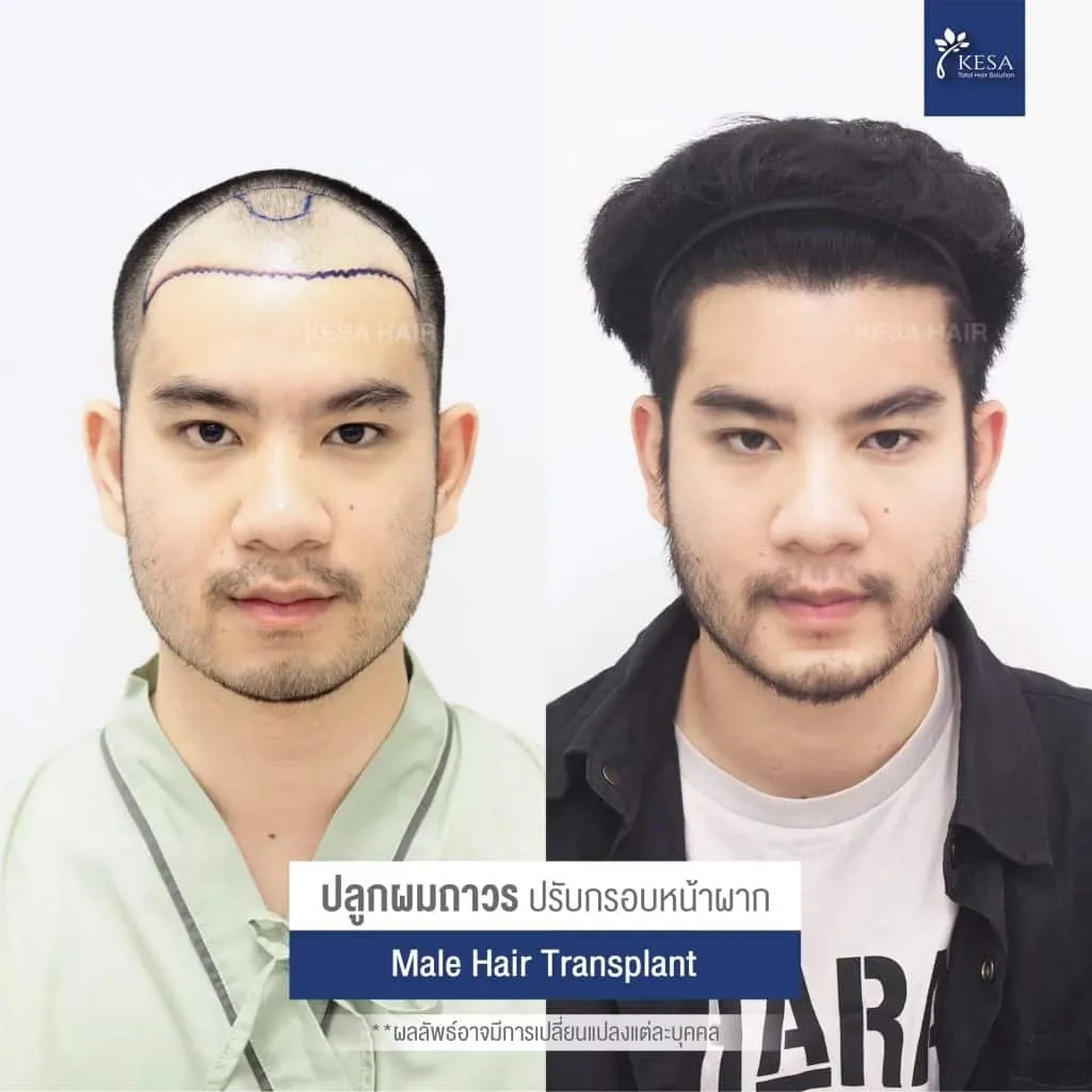 Review ปลูกผมที่เกศา