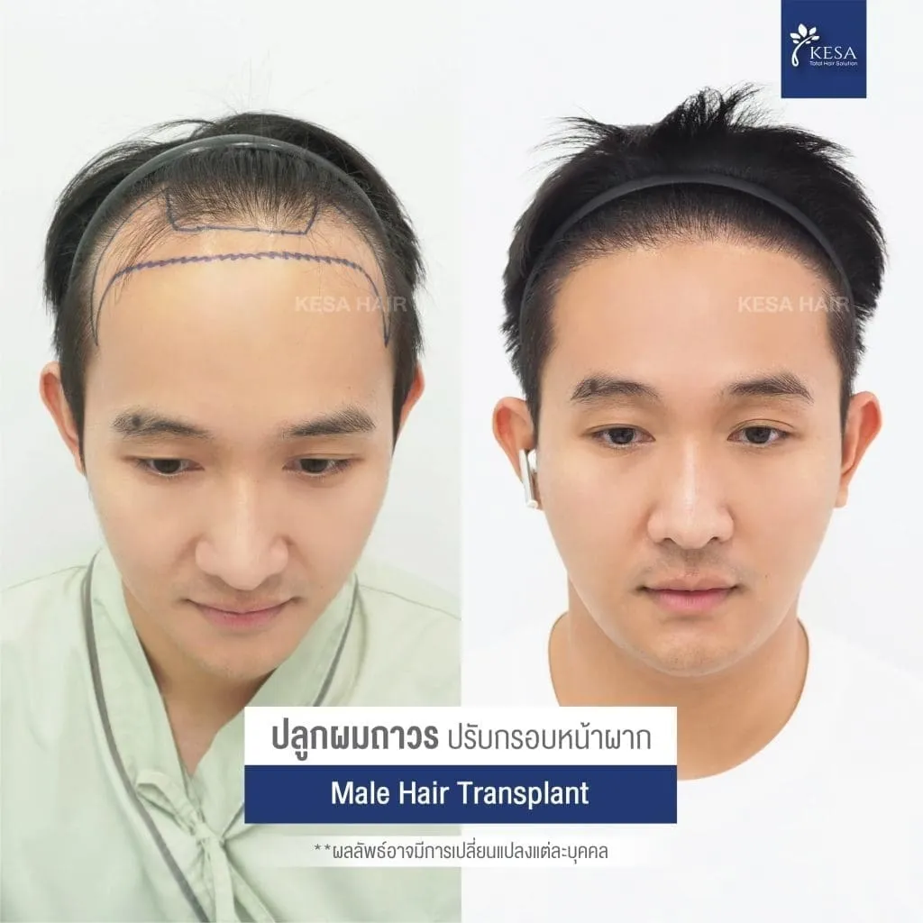 รีวิว ปลูกผม