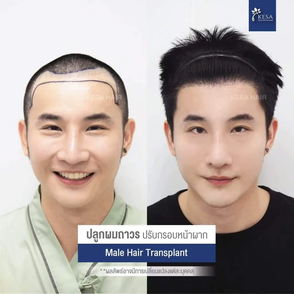 Review ปลูกผมที่เกศา