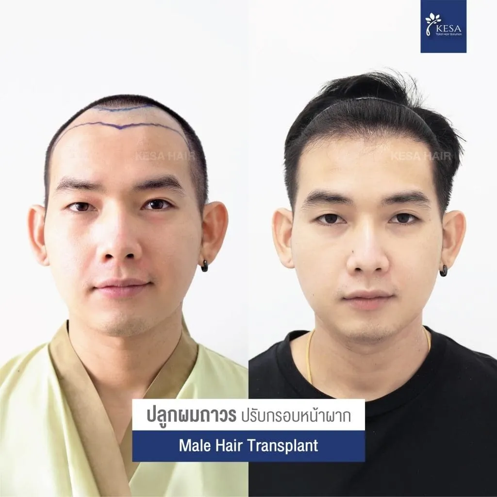 Review ปลูกผมที่เกศา