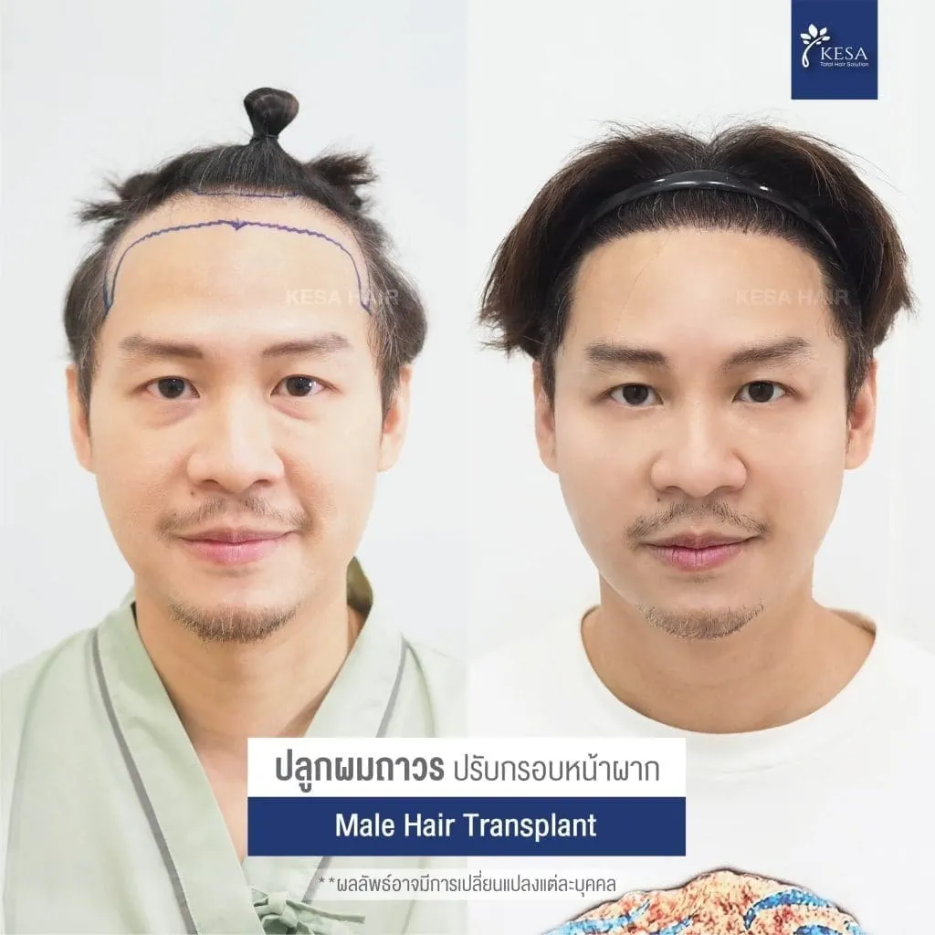 Review ปลูกผมที่เกศา