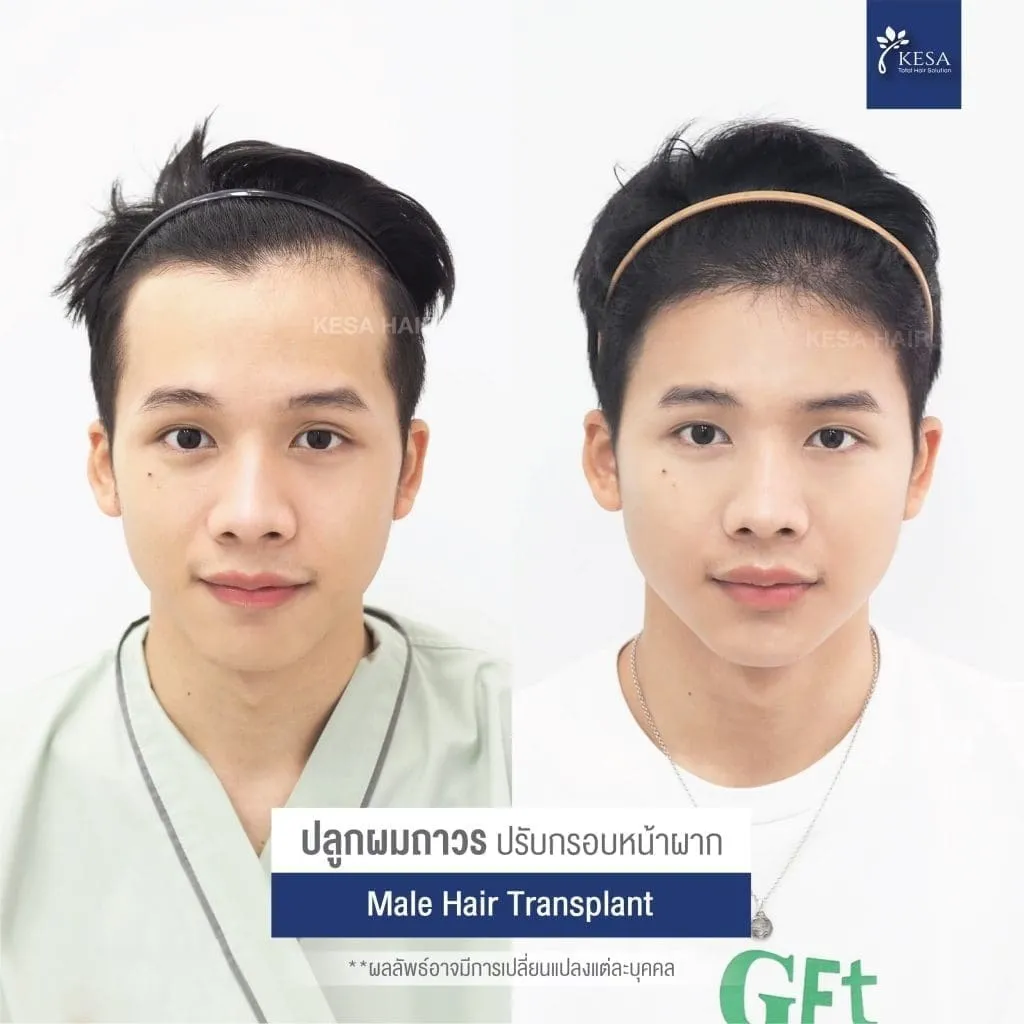 Review ปลูกผมที่เกศา