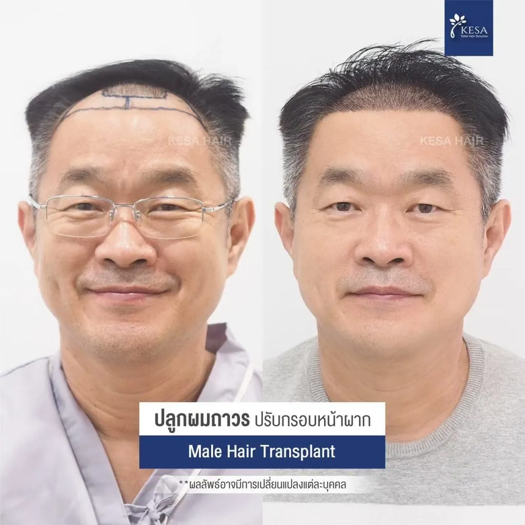 Review ปลูกผมที่เกศา