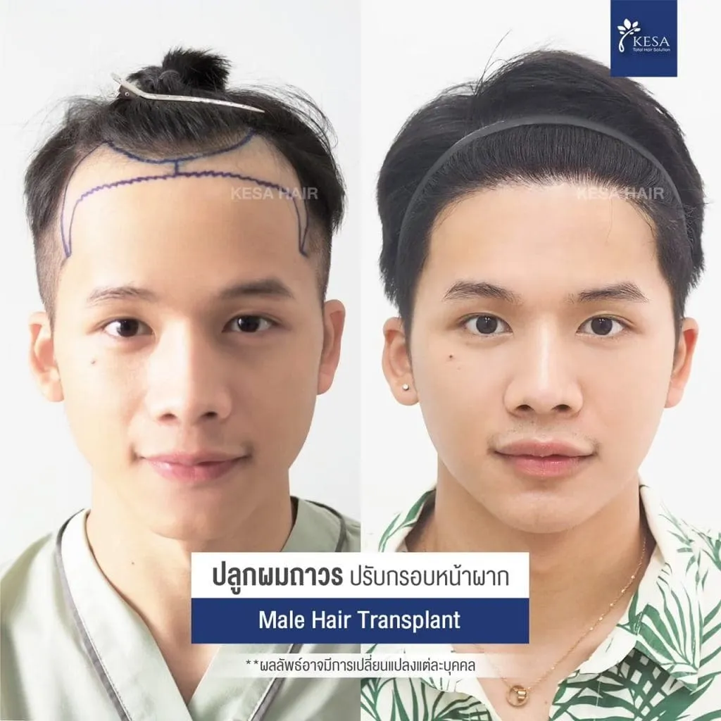 Review ปลูกผมที่เกศา