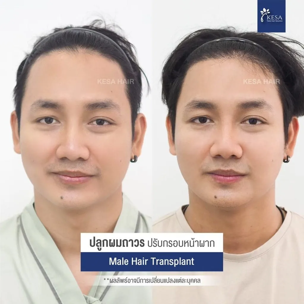 Review ปลูกผมที่เกศา