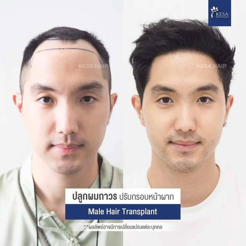 Review ปลูกผมที่เกศา