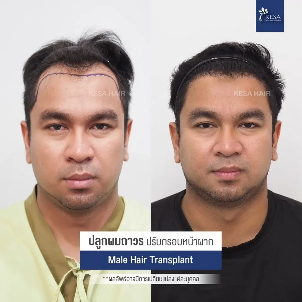 Review ปลูกผมที่เกศา