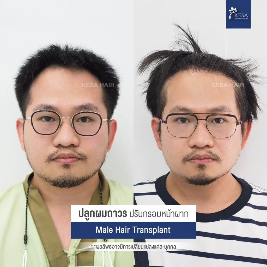 Review ปลูกผมที่เกศา