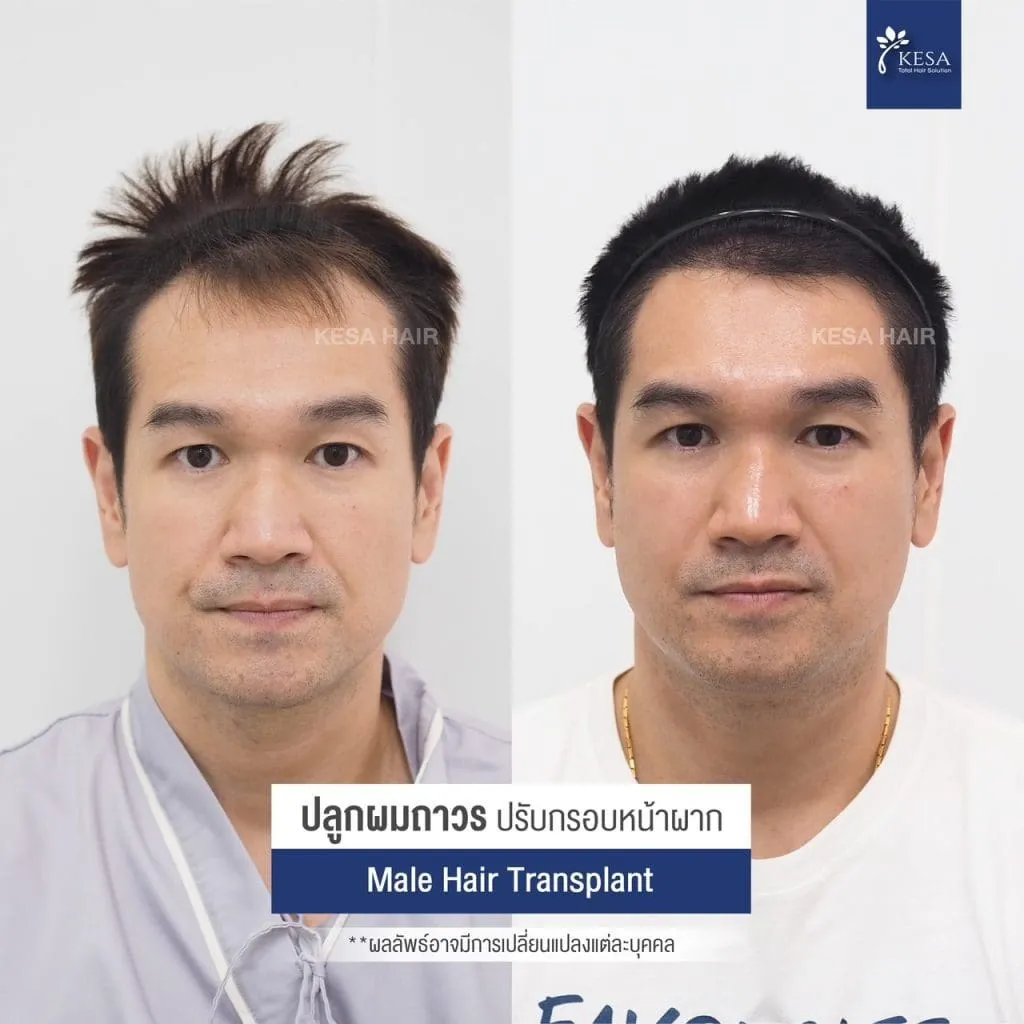 Review ปลูกผมที่เกศา