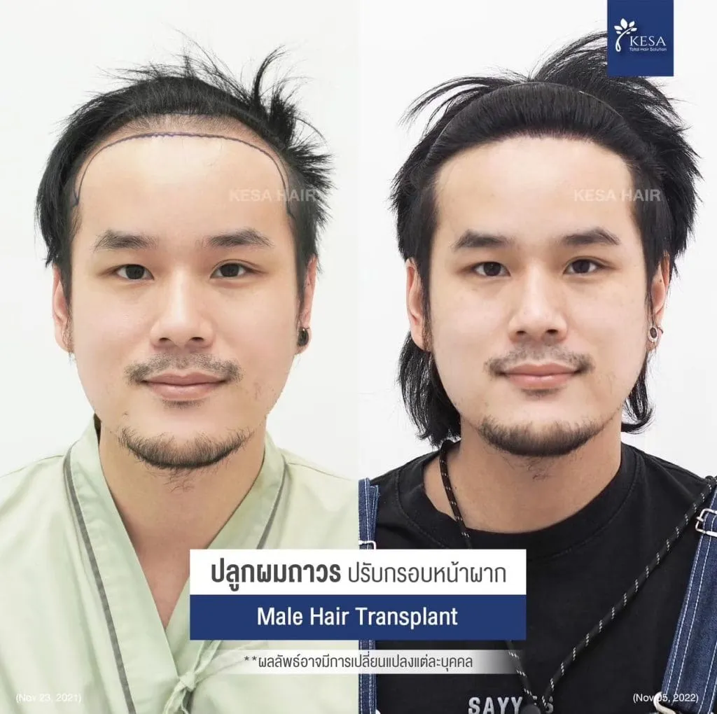 Review ปลูกผมที่เกศา