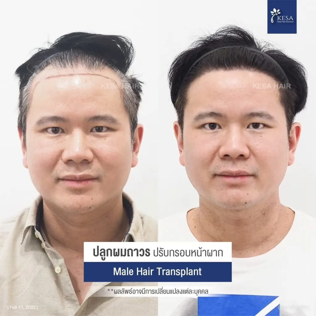 Review ปลูกผมที่เกศา