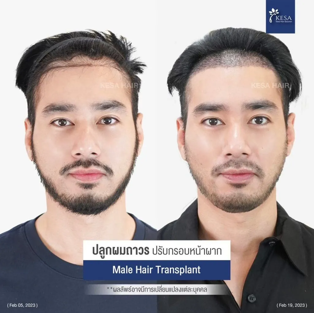 Review ปลูกผมที่เกศา