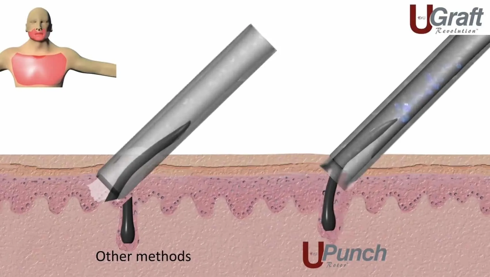 เครื่องเจาะรากผมระบบ Hybrid machine