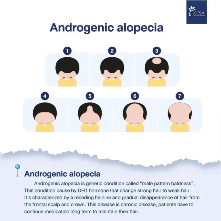 Androgenic alopecia เกศา คลินิก - kesa hair clinic