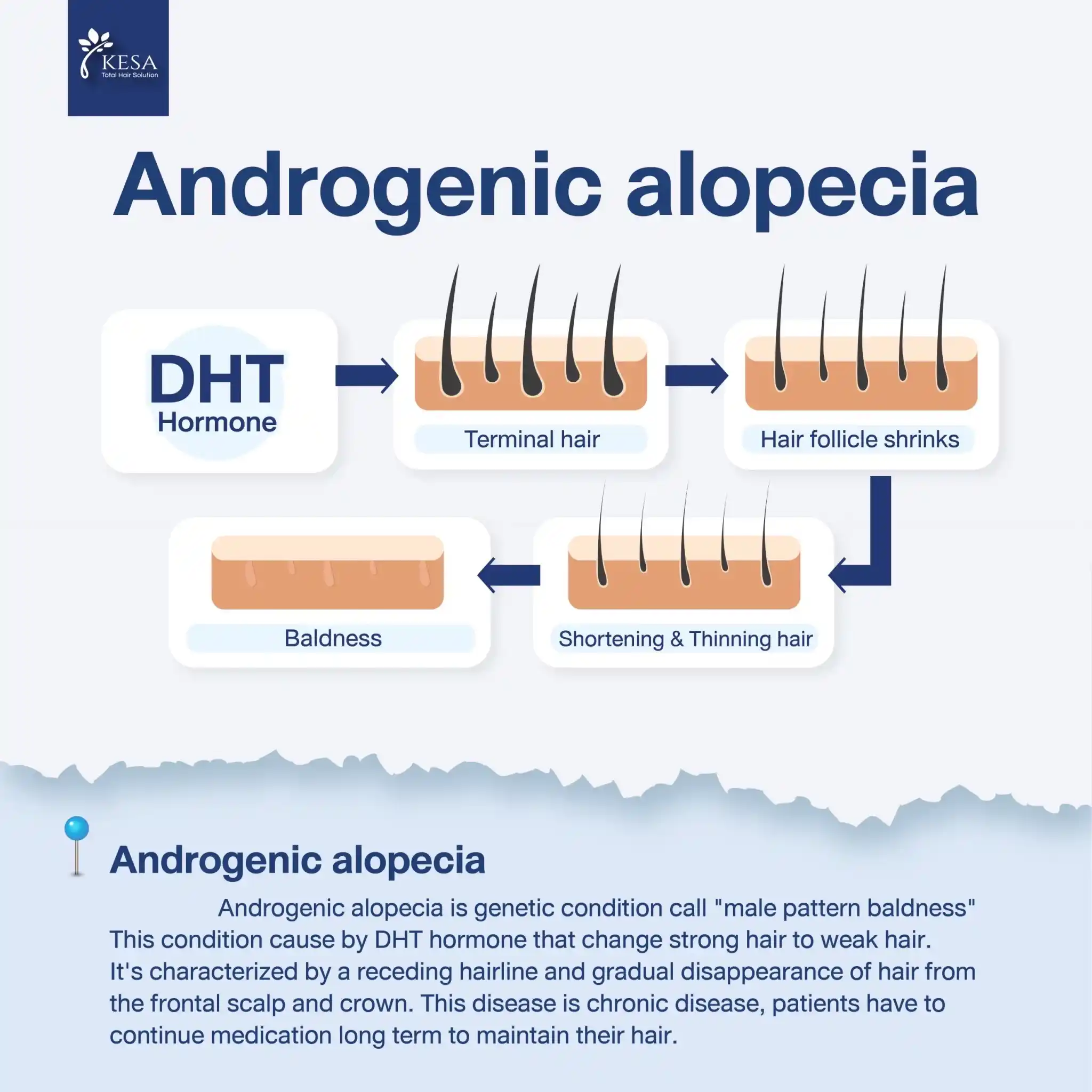 Androgenic alopecia เกศา คลินิก - kesa hair clinic