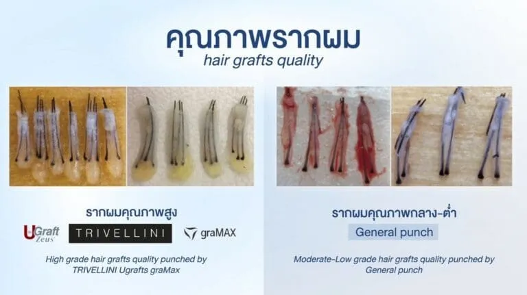grafts-quility-768x431 – เกศา คลินิก - kesa hair clinic คลินิกปลูกผม เกศา คลินิก - kesa hair clinic
