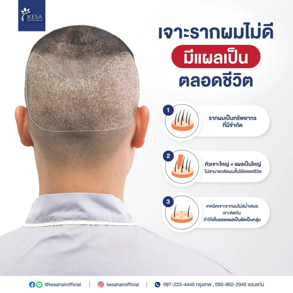 เจาะรากผมไม่ดี