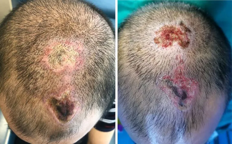 ปลูกผม เกศา คลินิก - kesa hair clinic