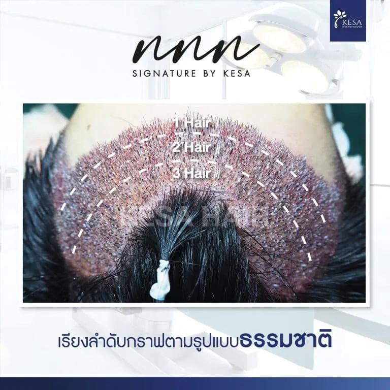 ปลูกผมธรรมชาติ