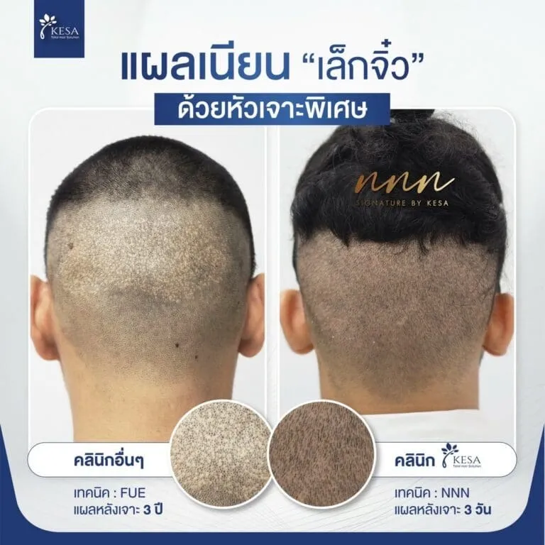 ขั้นตอนการเจาะรากผม เกศา คลินิก - kesa hair clinic
