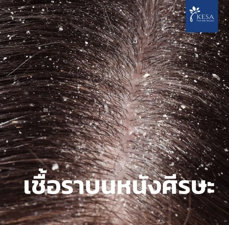 เชื้อราบนหนังศีรษะ เกศา คลินิก - kesa hair clinic