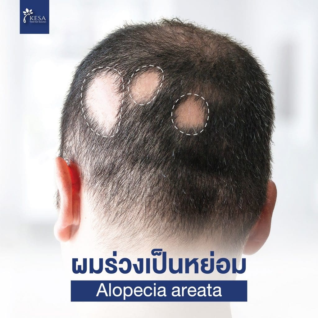 alopecia areata