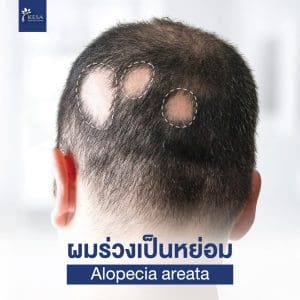 alopecia areata เกศา คลินิก - kesa hair clinic