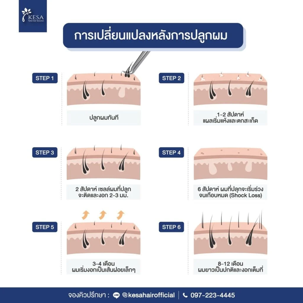 การเปลี่ยนแปลงหลัง ปลูกผมผู้หญิง