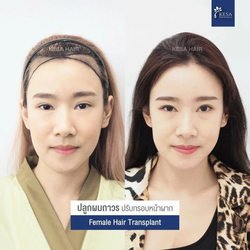 ปลูกผมปิดรอยแผลเป็น