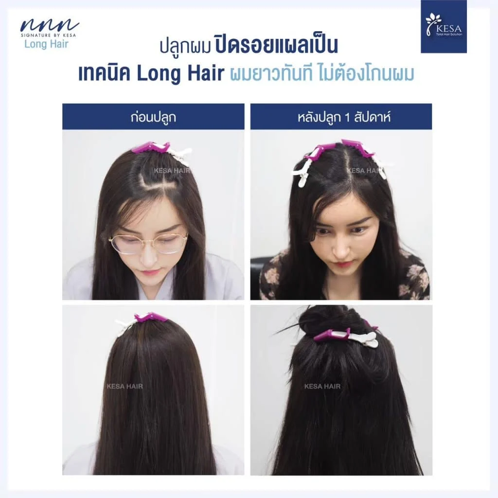ปลูกผมปิดรอยแผลเป็น เกศา คลินิก - kesa hair clinic