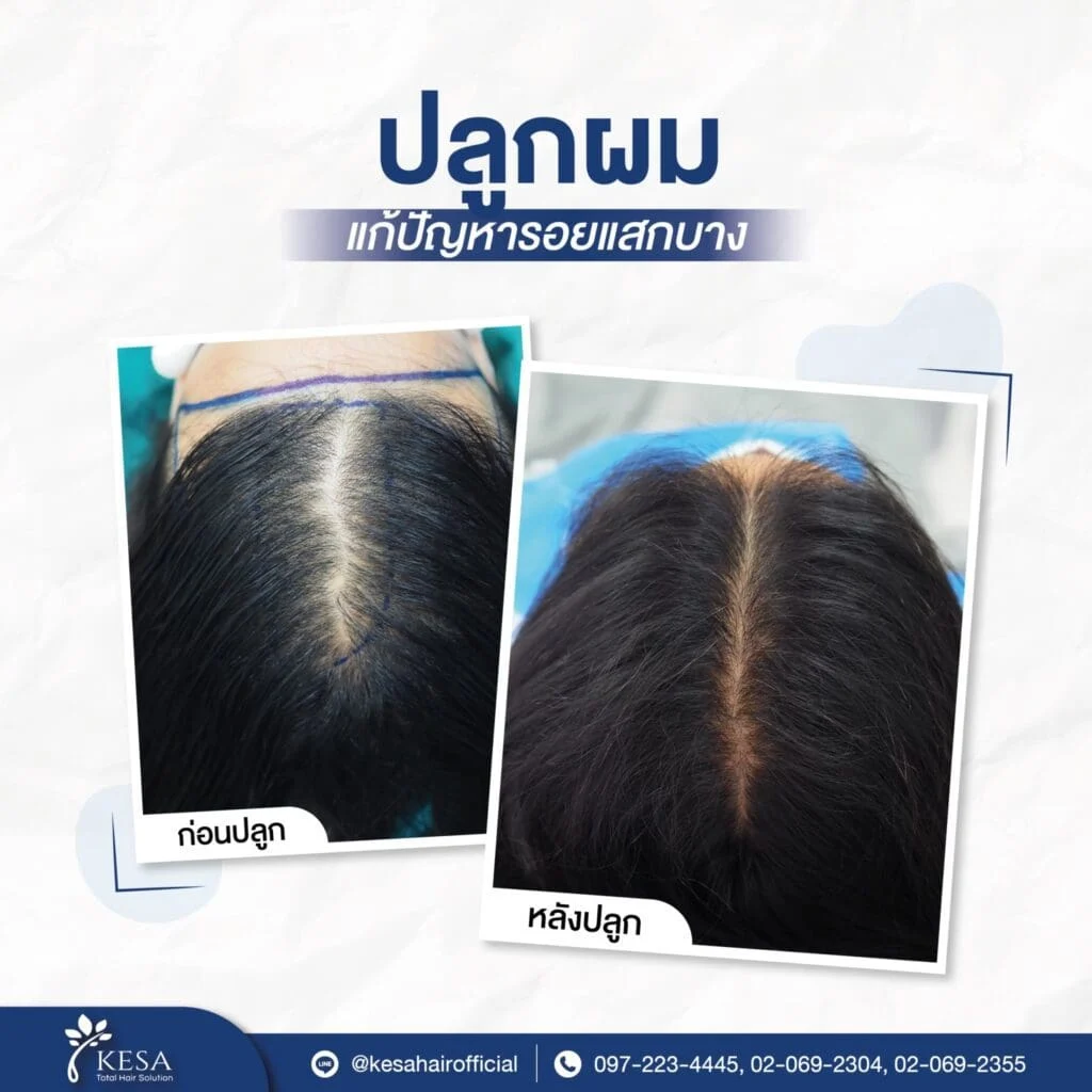 ปลูกผม ผู้หญิง