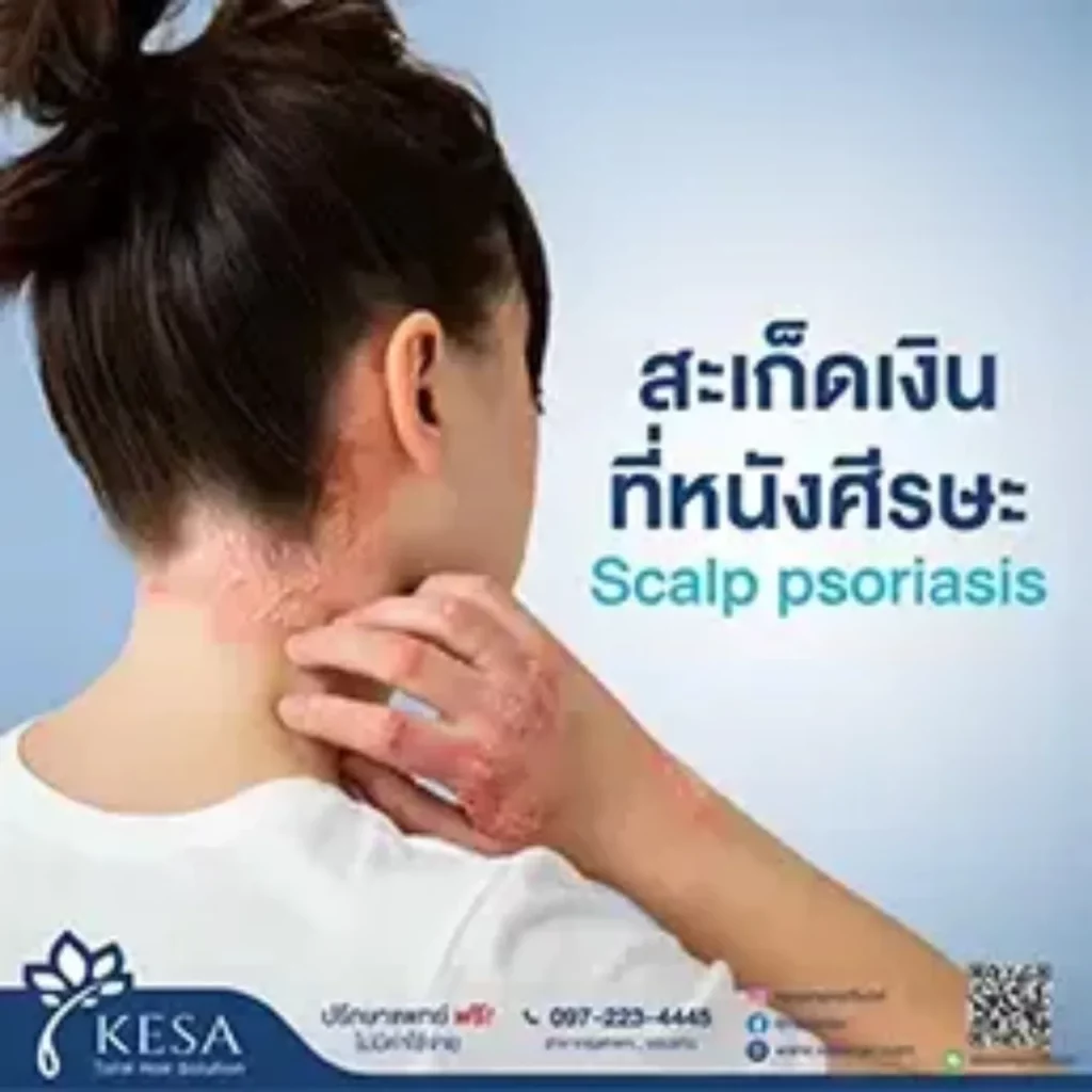 สะเก็ดเงินที่หนังศีรษะ เกศา คลินิก - kesa hair clinic เกศา คลินิก - kesa hair clinic